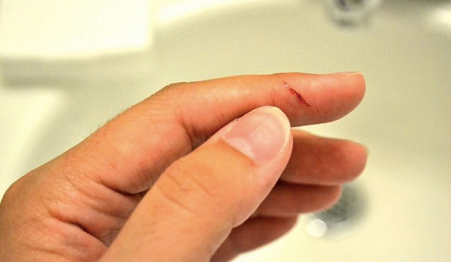 Bạn mơ thấy bàn tay chảy máu bị đứt lìa 