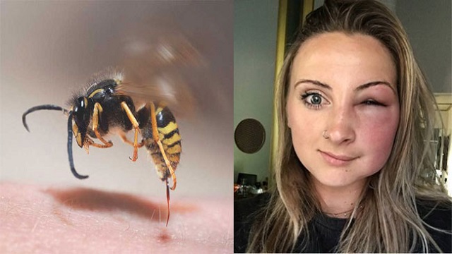 Nằm mơ thấy ong đốt trên mặt